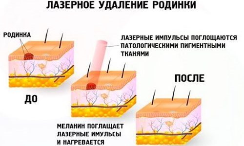 Comment se débarrasser des grains de beauté sur le visage avec une esthéticienne, méthodes à la maison