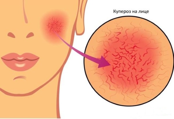 Élimination au laser des vaisseaux sanguins sur le visage avec un laser au néodyme, flash, elos. photos avant et après, avis