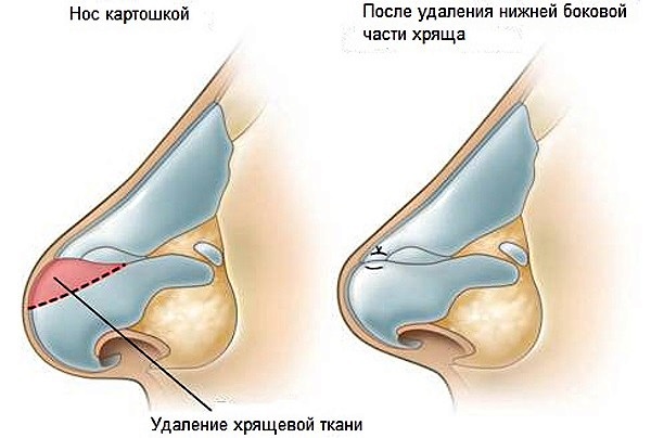 Comment réparer le nez d'une femme avec des pommes de terre. Rhinoplastie, photo avant et après chirurgie, prix