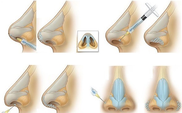 Rhinoplastie non chirurgicale du bout du nez avec remplissage, médicaments. Photo avant et après, prix