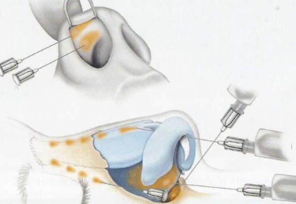 Rhinoplastie non chirurgicale du bout du nez avec remplissage, médicaments. Photo avant et après, prix