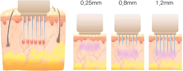 Mésothérapie fractionnelle du visage: indications, résultats, effets secondaires, conséquences. Commentaires