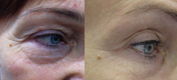 Rajeunissement du visage au plasma. Types de procédures, appareils, photos avant et après, avis