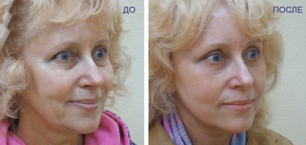 Rajeunissement du visage au plasma. Types de procédures, appareils, photos avant et après, avis