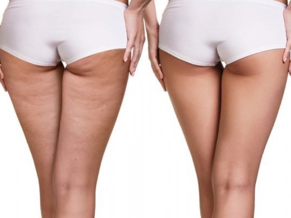 Comment faire correctement un enveloppement anti-cellulite à la maison. Recettes