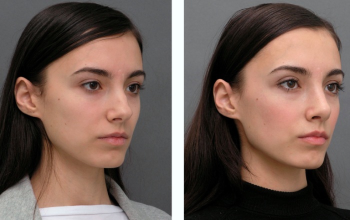 Rhinoplastie non chirurgicale du nez. Photo, comment c'est fait, comment choisir une clinique, un médecin. Commentaires