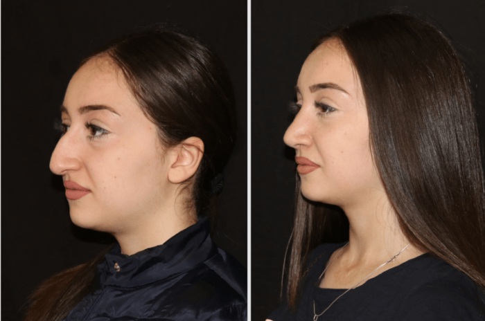 Rhinoplastie non chirurgicale du nez. Photo, comment c'est fait, comment choisir une clinique, un médecin. Commentaires