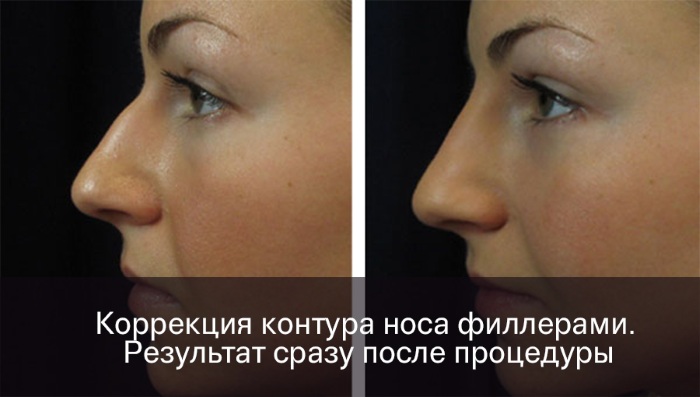 Rhinoplastie non chirurgicale du nez. Photo, comment c'est fait, comment choisir une clinique, un médecin. Commentaires