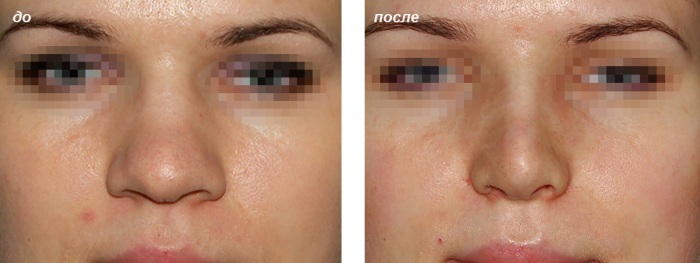 Rhinoplastie non chirurgicale du nez. Photo, comment c'est fait, comment choisir une clinique, un médecin. Commentaires