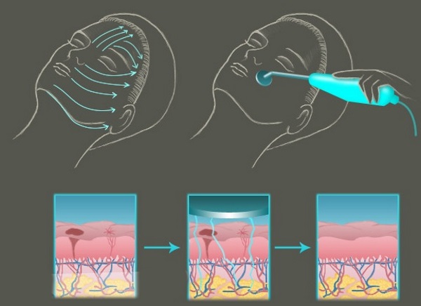 Darsonval pour le visage.Comment l'utiliser correctement. Vidéos, critiques