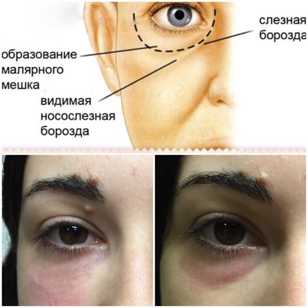 Effet Tyndall en cosmétologie sous les yeux, sur la peau des lèvres. Lorsqu'on observe comment supprimer