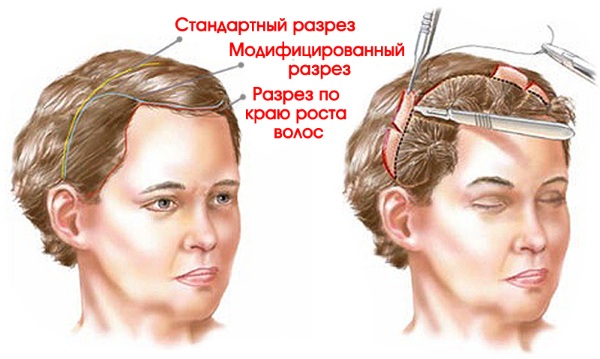 Lifting endoscopique du front et des sourcils. Photos avant et après, comment c'est fait, conséquences, critiques