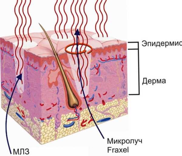 Thérapie au laser Fraxel pour la peau du visage. Indications, photos avant et après, avis