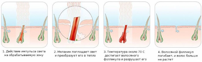 Épilation dans la zone profonde du bikini. Sucre, épilation au laser, épilation à la cire, photoépilation, électrolyse, bioépilation