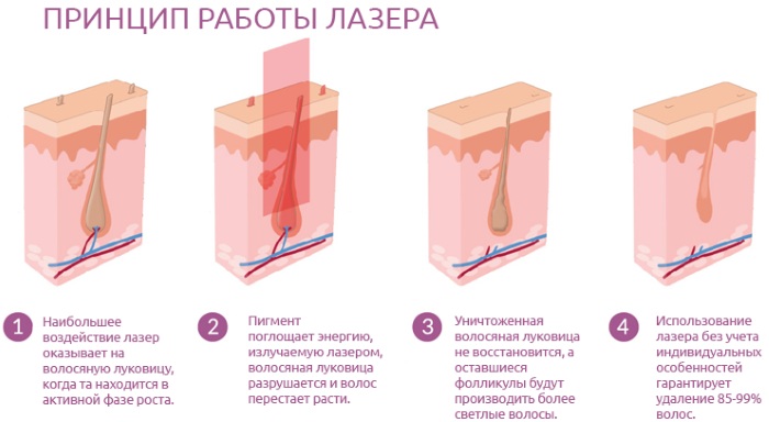 Épilation dans la zone profonde du bikini. Sucre, épilation au laser, épilation à la cire, photoépilation, électrolyse, bioépilation