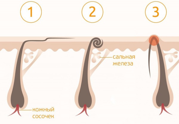 Comment se débarrasser définitivement des poils du corps. Remèdes populaires, procédures cosmétiques