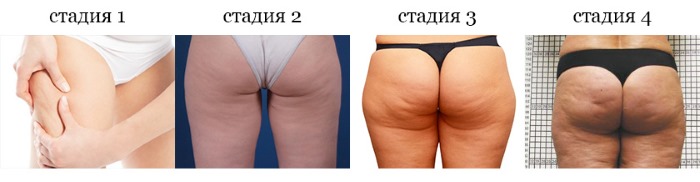 Comment éliminer la cellulite sur les jambes et le bas. Exercices pour la semaine, programme de formation pour filles