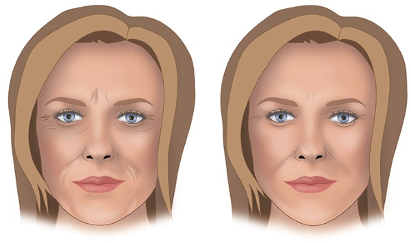 Contour du nez, des pommettes, des lèvres, du menton, des plis nasogéniens. Comment est-ce fait, prix, avis