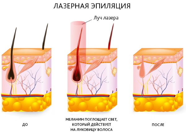 Épilation au laser de la lèvre supérieure (antennes) chez la femme. Combien de sessions sont nécessaires, comment est-ce fait