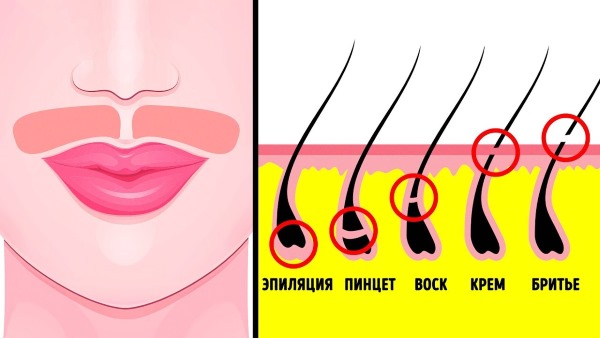 Épilation au laser de la lèvre supérieure (antennes) chez la femme. Combien de sessions sont nécessaires, comment est-ce fait