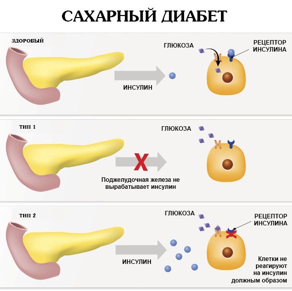 Épilation dans la zone profonde du bikini. Sucre, épilation au laser, épilation à la cire, photoépilation, électrolyse, bioépilation