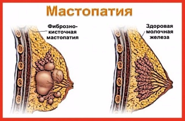 Mammoplastie de chirurgie de réduction mammaire. Combien coûte un lifting, types, comment le faire gratuitement