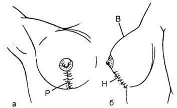 Mammoplastie de chirurgie de réduction mammaire. Combien coûte un lifting, types, comment le faire gratuitement