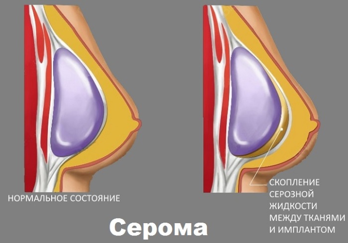 Mammoplastie de chirurgie de réduction mammaire. Combien coûte un lifting, types, comment le faire gratuitement