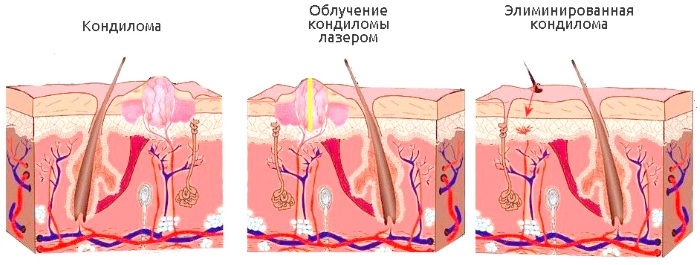 Élimination au laser des néoplasmes de la peau, des excroissances, des papillomes. Comment est la procédure, le prix, les avis