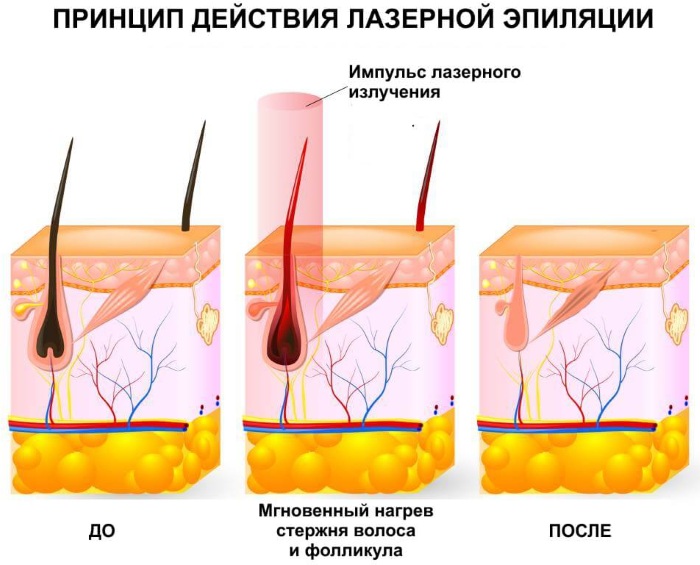 Comment se débarrasser définitivement des poils du visage. Méthodes cosmétologiques à domicile