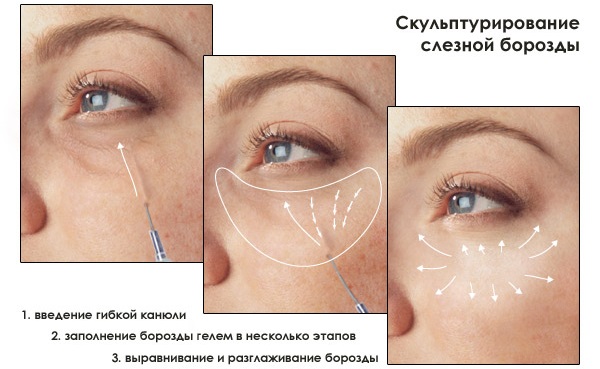 Plastie de contour de la rainure nasolacrymale. Photos avant et après, complications, avis