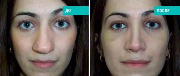 Les filles ont un nez large. Que faire, comment s'en débarrasser, rhinoplastie