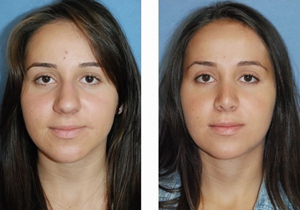 Les filles ont un nez large. Que faire, comment s'en débarrasser, rhinoplastie