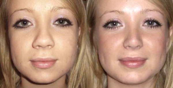 Les filles ont un nez large. Que faire, comment s'en débarrasser, rhinoplastie