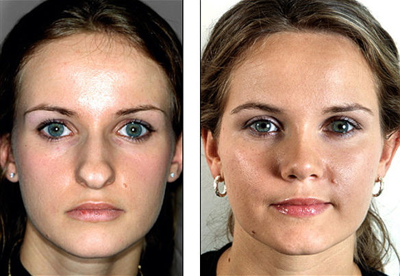 Les filles ont un nez large. Que faire, comment s'en débarrasser, rhinoplastie