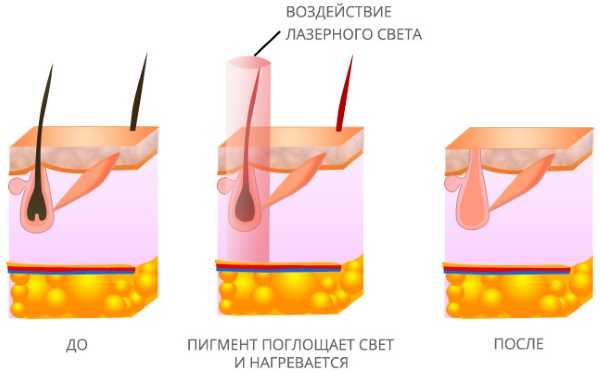 Épilation / épilation à domicile avec cire / sucre / miel, shugaring. Comment faire, recettes