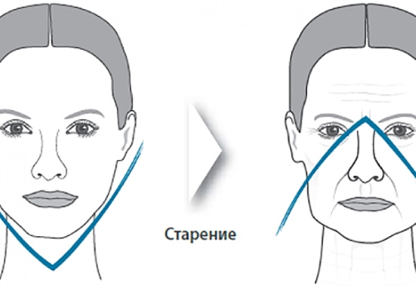 Lifting chirurgical. Prix, comment choisir un médecin, types de chirurgie