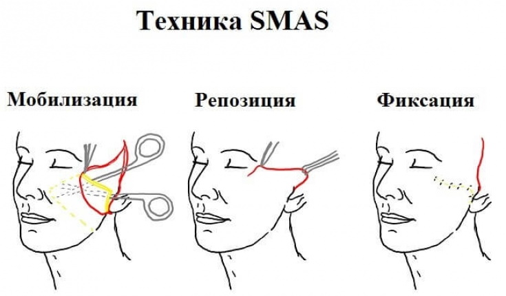 Lifting chirurgical. Prix, comment choisir un médecin, types de chirurgie