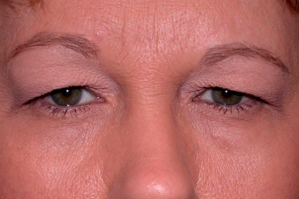 Lifting des paupières chirurgical et non chirurgical. Blépharoplastie circulaire, mésothreads, laser, botox. Photos, prix