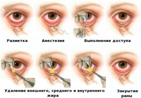 Lifting des paupières chirurgical et non chirurgical. Blépharoplastie circulaire, mésothreads, laser, botox. Photos, prix