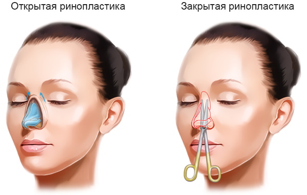 Rhinoplastie du nez: fermé, ouvert, reconstructif, injection, laser. Prix ​​et avis