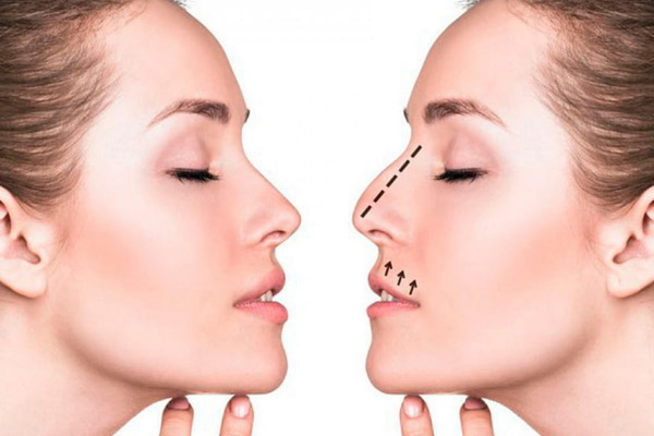 Rhinoplastie du nez: fermé, ouvert, reconstructif, injection, laser. Prix ​​et avis