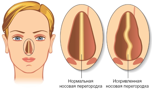 Rhinoplastie du nez: fermé, ouvert, reconstructif, injection, laser. Prix ​​et avis