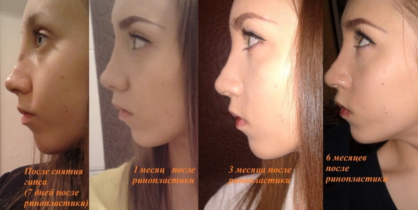 Rhinoplastie du nez: fermé, ouvert, reconstructif, injection, laser. Prix ​​et avis