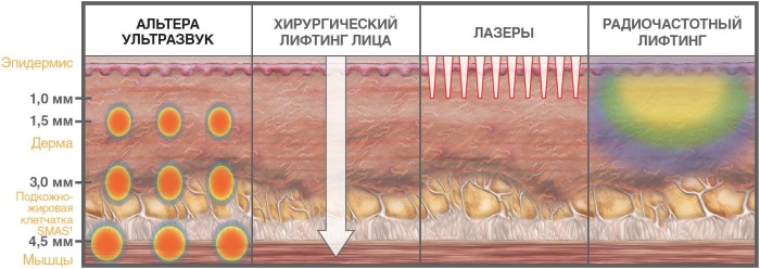 Thérapie Ulthera (Altera) en cosmétologie matérielle. Photos avant et après, prix, avis