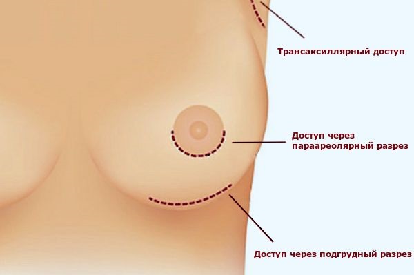 Chirurgie d'augmentation mammaire. Photos de filles aux gros seins, résultats, complications possibles