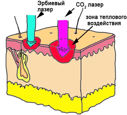 Laser Erbium en cosmétologie. Photos avant et après, résultats de l'application, avis