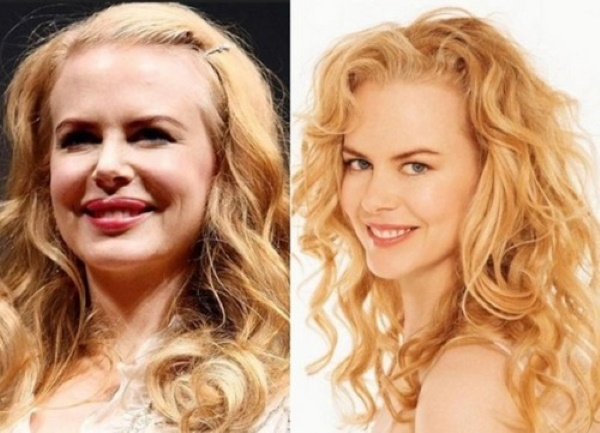 Nicole Kidman. Photos avant et après la chirurgie plastique, chez les jeunes, maintenant, figure