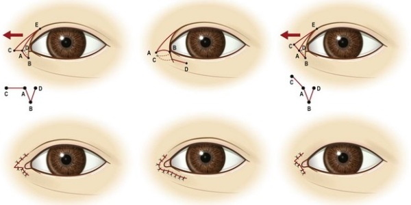 Cantopexy - qu'est-ce que c'est, types de lifting des paupières, photos avant et après, prix, avis