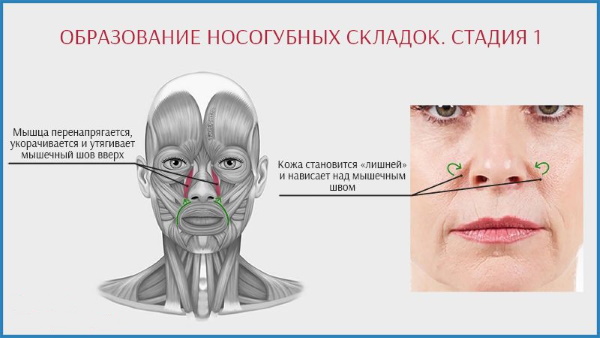 Gymnastique pour plis nasogéniens, exercices, remplisseurs de patch. Comment s'en débarrasser à la maison